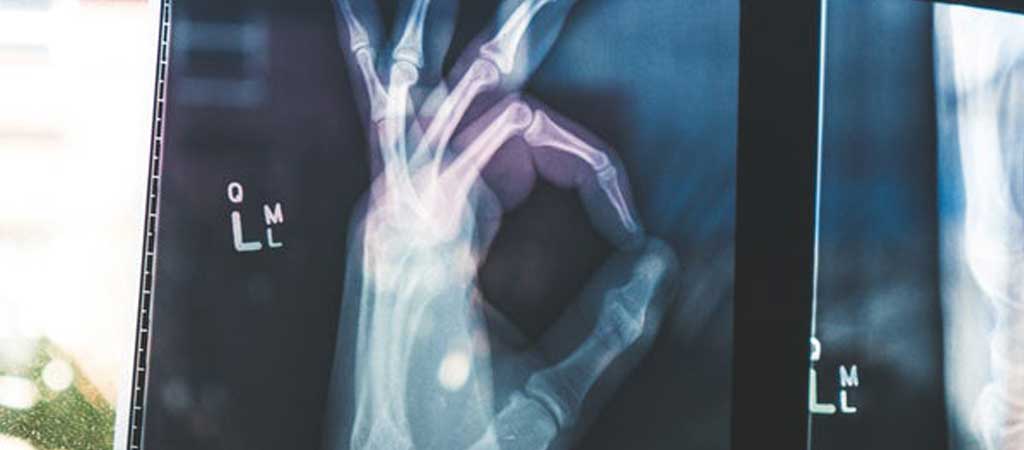 Ostéoporose et nutrition : comment conserver des os solides ?